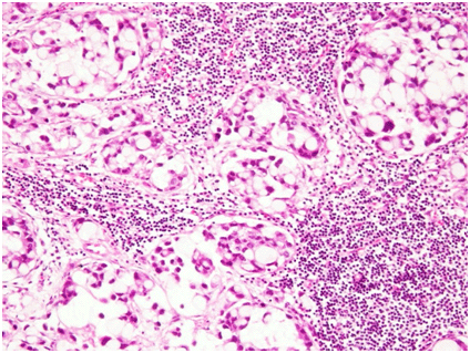 signet ring cell carcinoma 